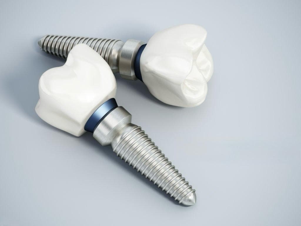Dental Implant